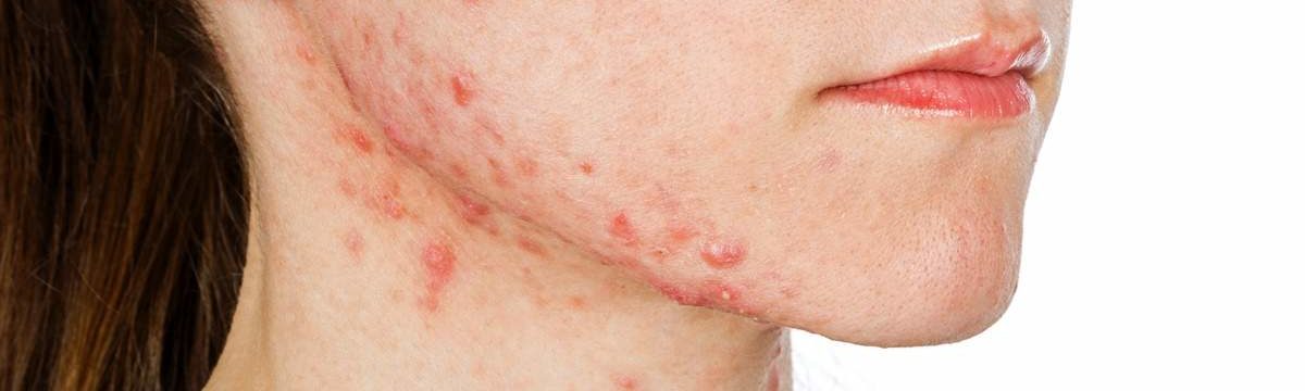 acne