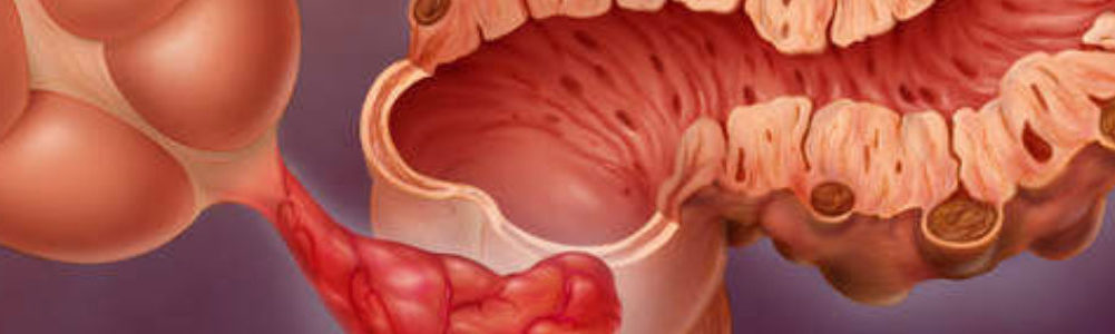 Diverticulos
