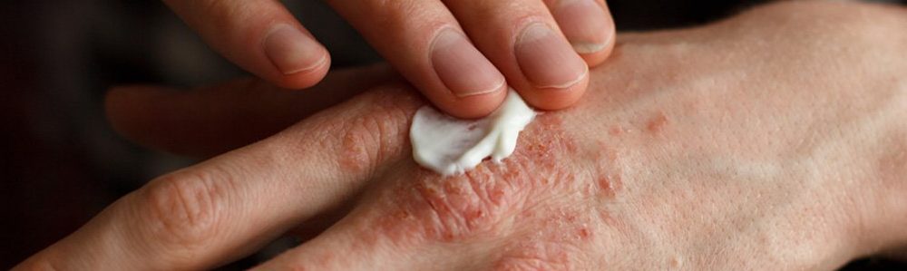O que é Eczema, suas causas e sintomas