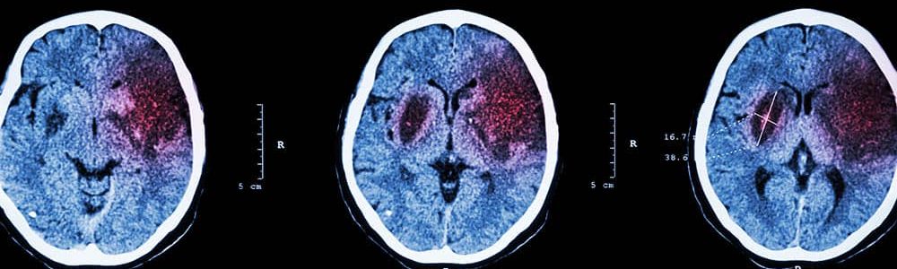 O que é Embolia Cerebral e seus sintomas