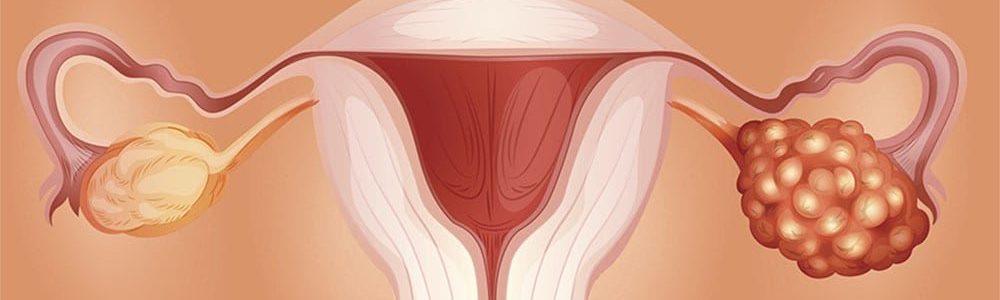 Endometriose - o que é, e quais os sintomas