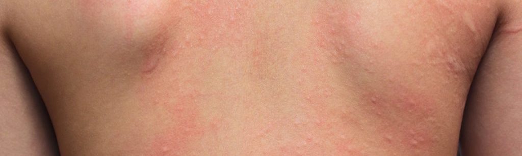 alergia