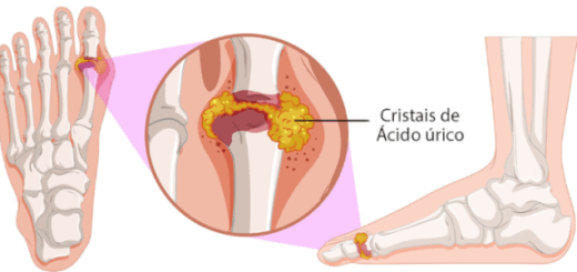 Ácido Úrico Alto: Causas, Sintomas e Como Tratar a Gota