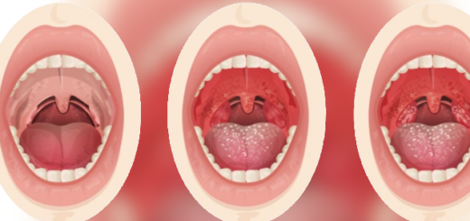 Estágios da Amigdalite