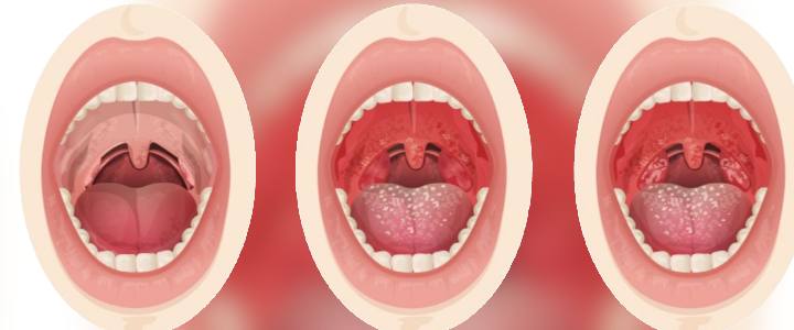 Estágios da Amigdalite