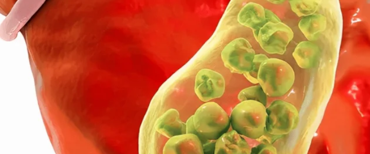 Cálculo Biliar (Pedra na Vesícula)