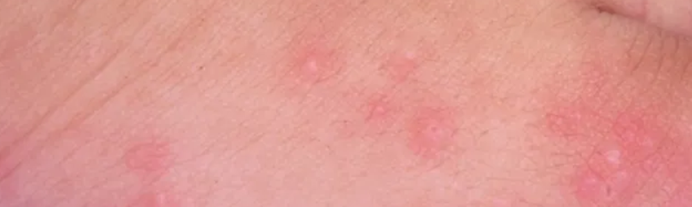 Dermatite Alérgica Dermatite Alérgica