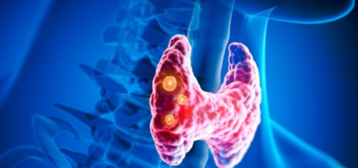 Hipertireoidismo (Alta atividade da tireóide)