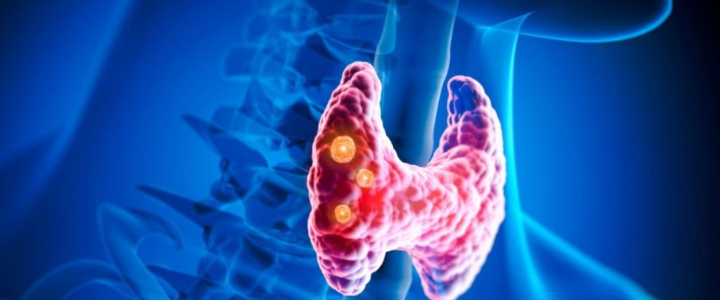 Hipertireoidismo (Alta atividade da tireóide)