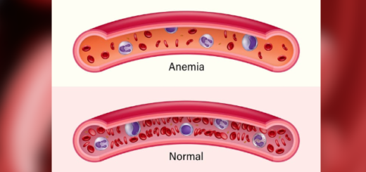 Guia completo sobre anemia