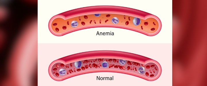 Guia completo sobre anemia