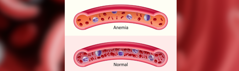Anemia Anemia