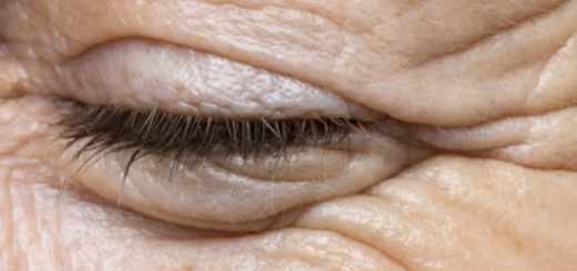 Rugas ao redor dos olhos