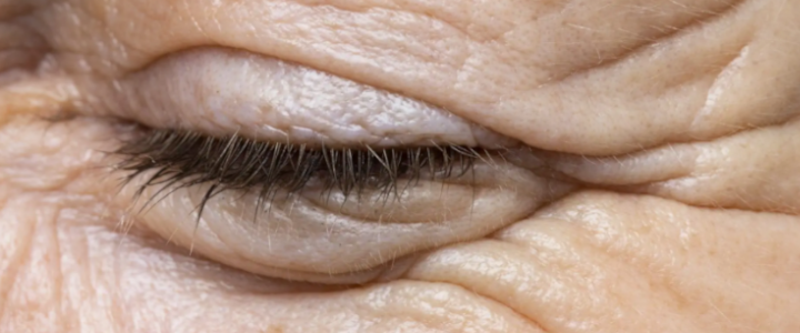 Rugas ao redor dos olhos